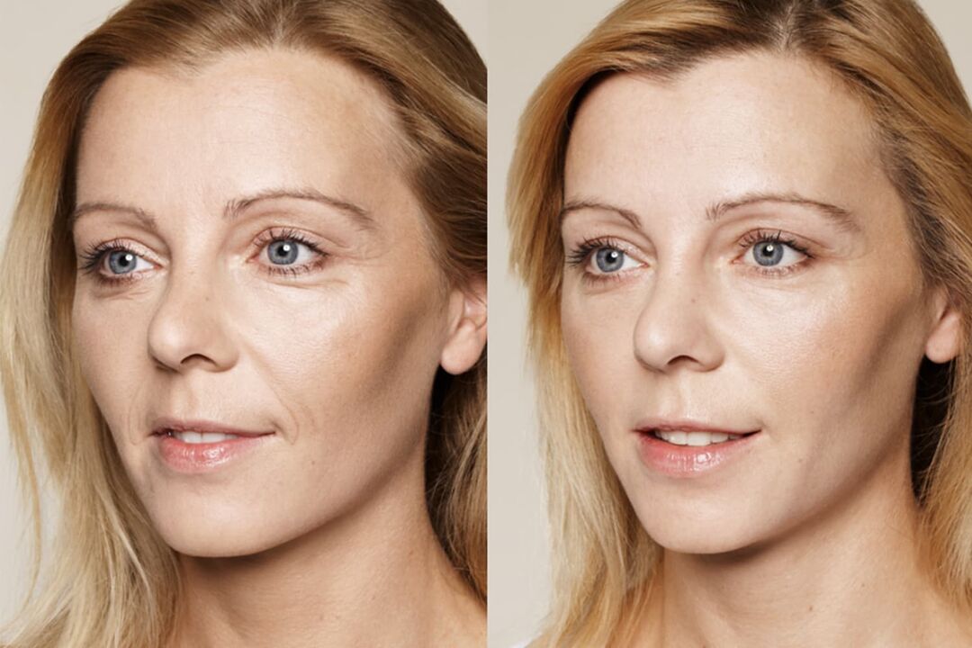 Usage experience before and after using Valeria's intenskin cream